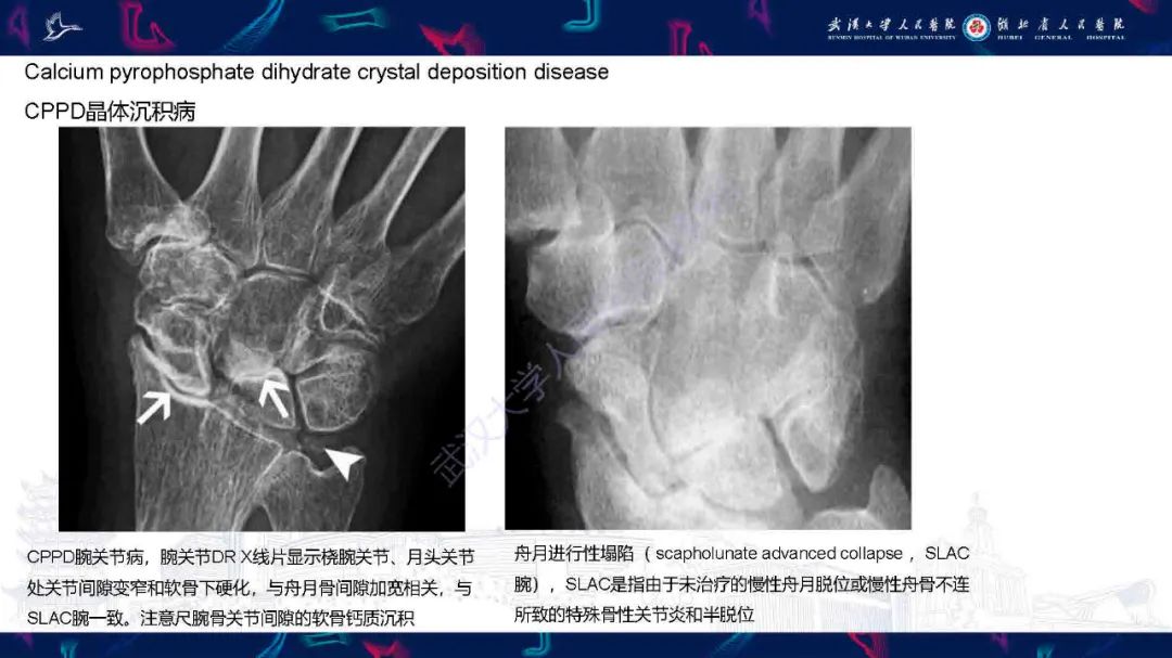 影像PPT - 【PPT】软组织钙化影像诊断-15