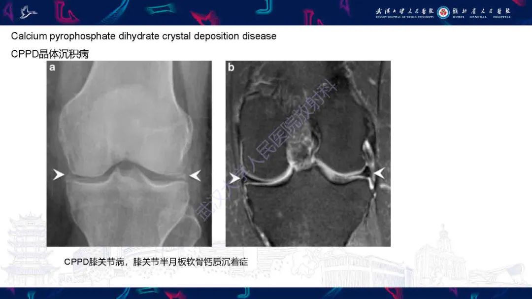 影像PPT - 【PPT】软组织钙化影像诊断-16