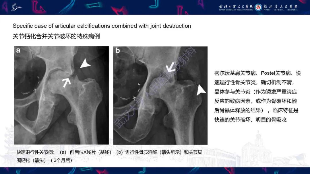 影像PPT - 【PPT】软组织钙化影像诊断-17