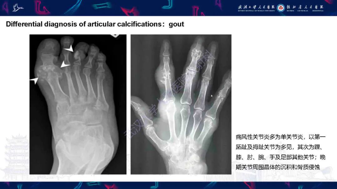 影像PPT - 【PPT】软组织钙化影像诊断-19