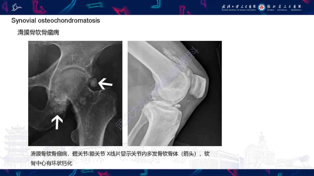影像PPT - 【PPT】软组织钙化影像诊断-21