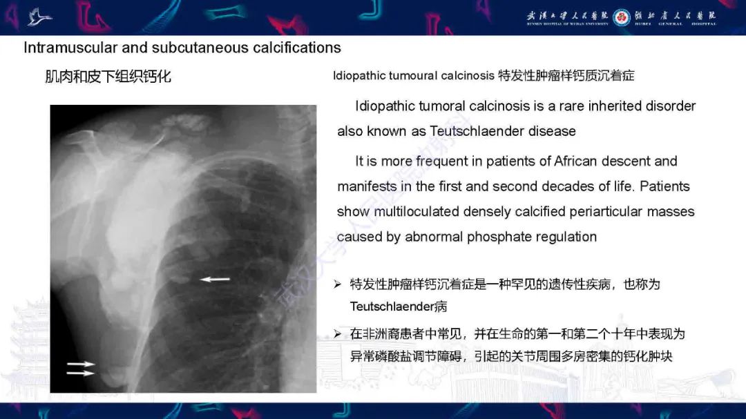 影像PPT - 【PPT】软组织钙化影像诊断-22
