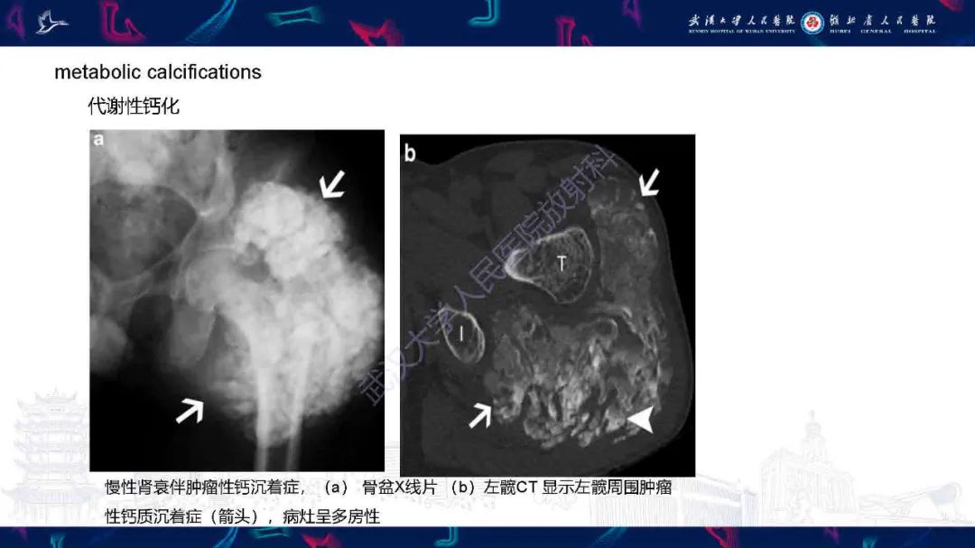 影像PPT - 【PPT】软组织钙化影像诊断-24