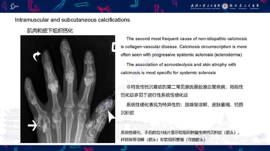 影像PPT - 【PPT】软组织钙化影像诊断-25