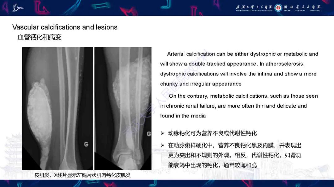 影像PPT - 【PPT】软组织钙化影像诊断-26