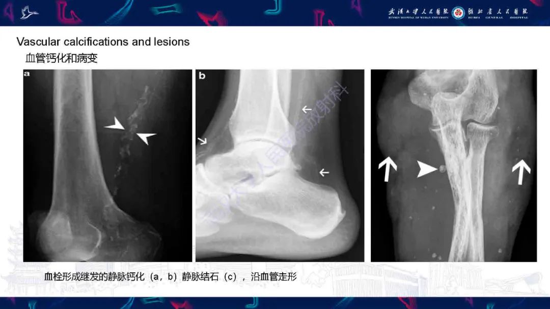 影像PPT - 【PPT】软组织钙化影像诊断-27
