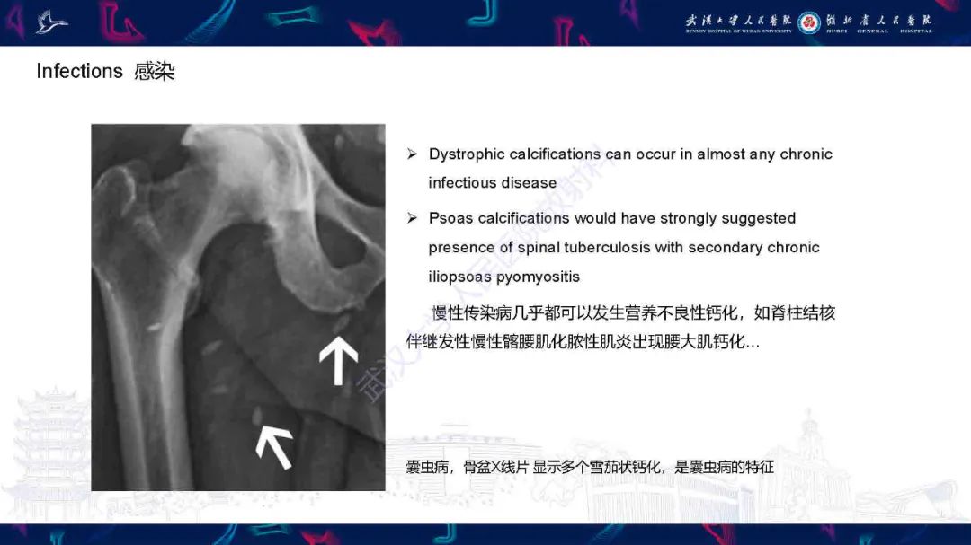 影像PPT - 【PPT】软组织钙化影像诊断-28