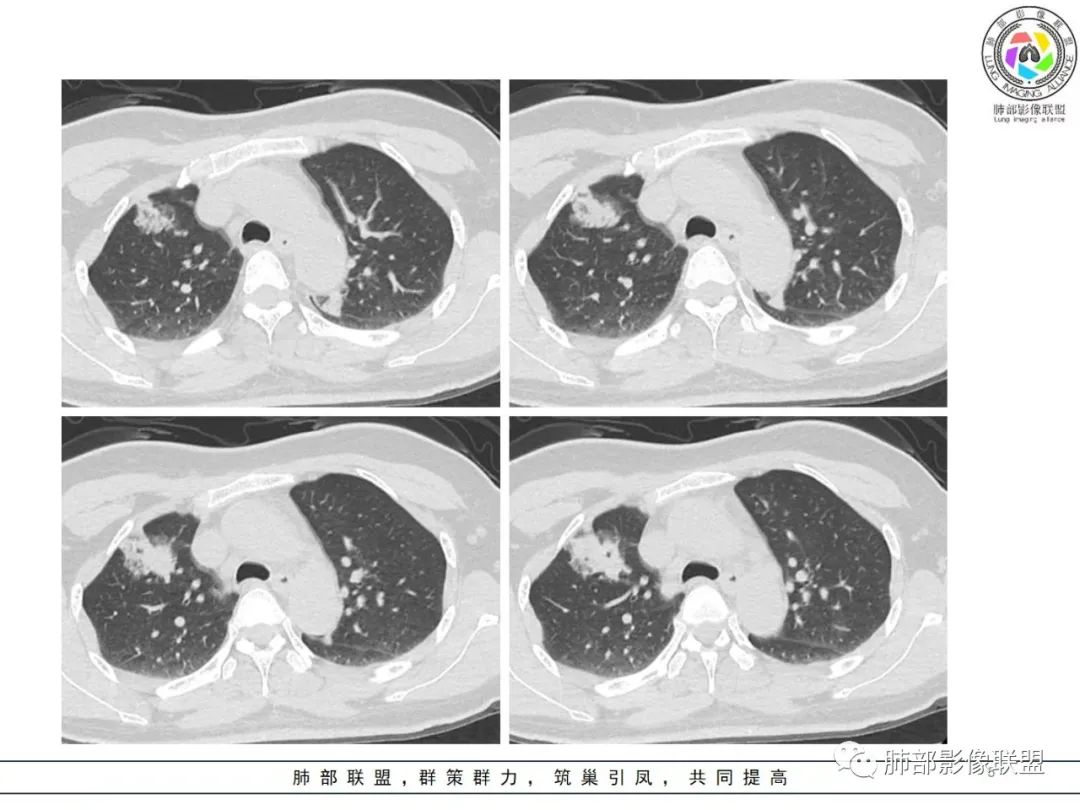 影像PPT - 【病例】粘液腺癌1例肺部CT影像特点及相关知识拓展-5 影像PPT - 【病例】粘液腺癌1例肺部CT影像特点及相关知识拓展-5