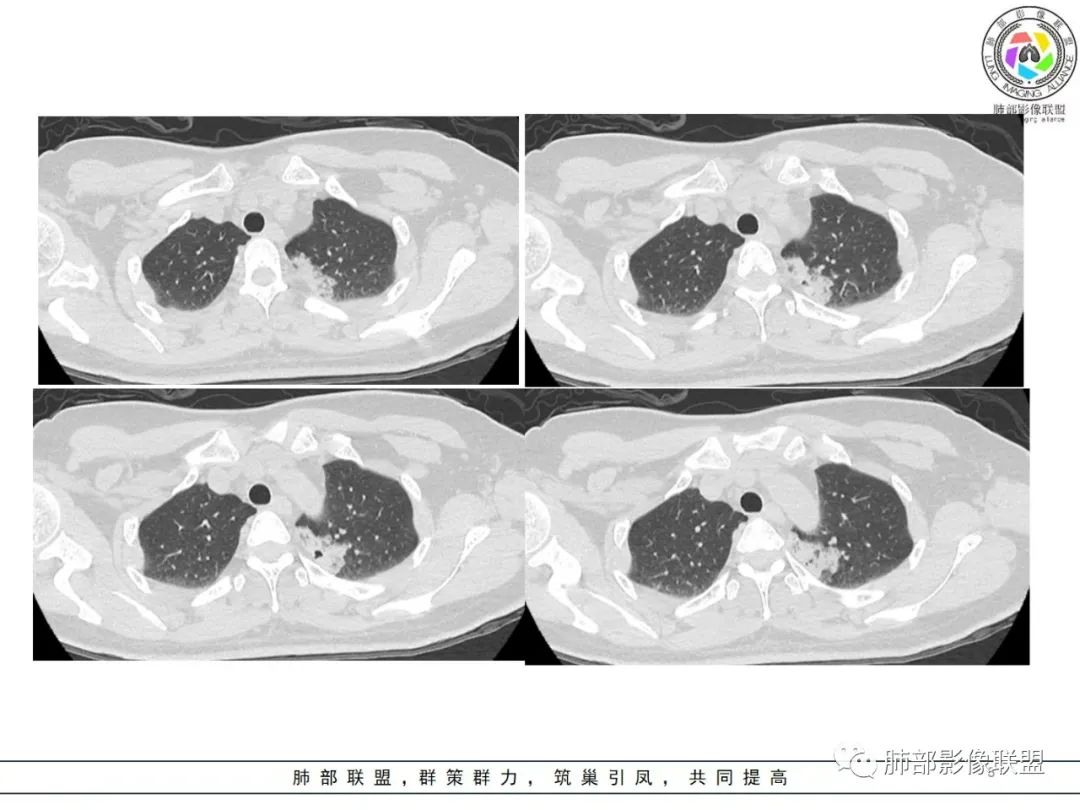 影像PPT - 【病例】粘液腺癌1例肺部CT影像特点及相关知识拓展-3 影像PPT - 【病例】粘液腺癌1例肺部CT影像特点及相关知识拓展-3