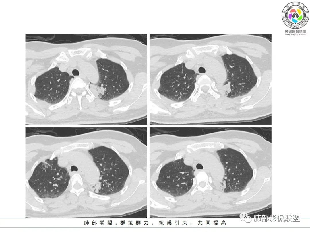 影像PPT - 【病例】粘液腺癌1例肺部CT影像特点及相关知识拓展-4 影像PPT - 【病例】粘液腺癌1例肺部CT影像特点及相关知识拓展-4