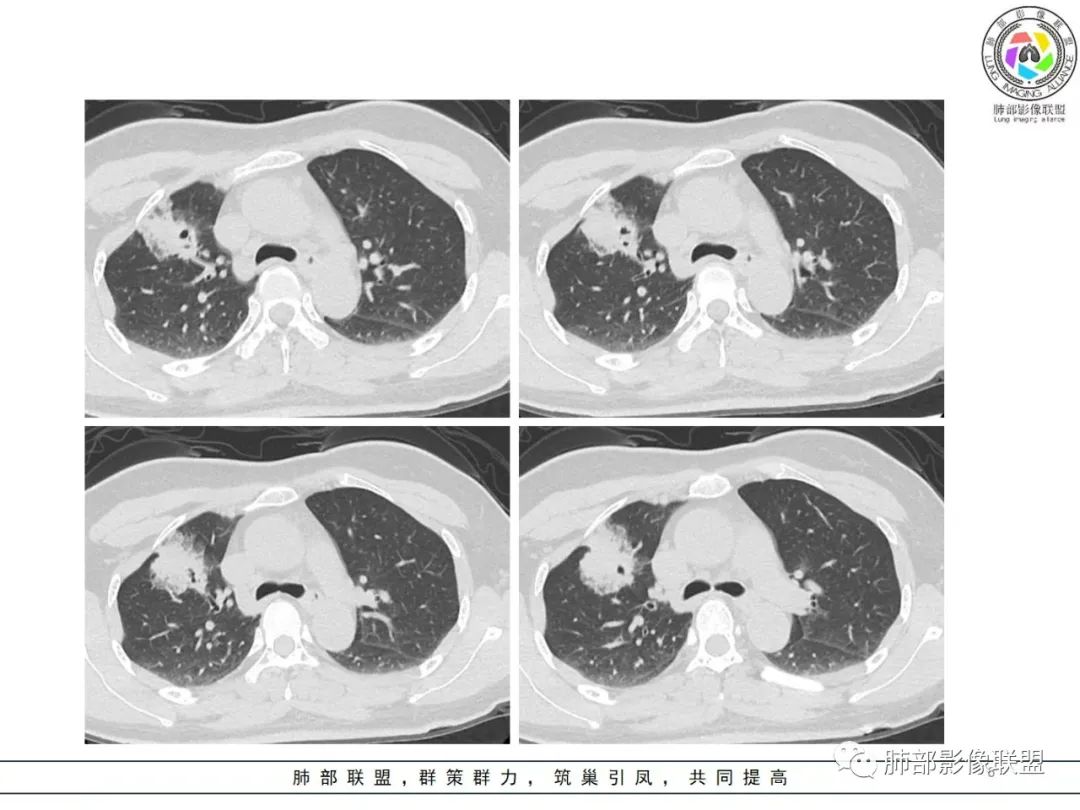 影像PPT - 【病例】粘液腺癌1例肺部CT影像特点及相关知识拓展-6 影像PPT - 【病例】粘液腺癌1例肺部CT影像特点及相关知识拓展-6
