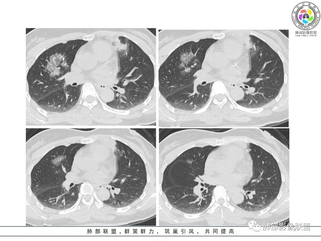 影像PPT - 【病例】粘液腺癌1例肺部CT影像特点及相关知识拓展-9 影像PPT - 【病例】粘液腺癌1例肺部CT影像特点及相关知识拓展-9