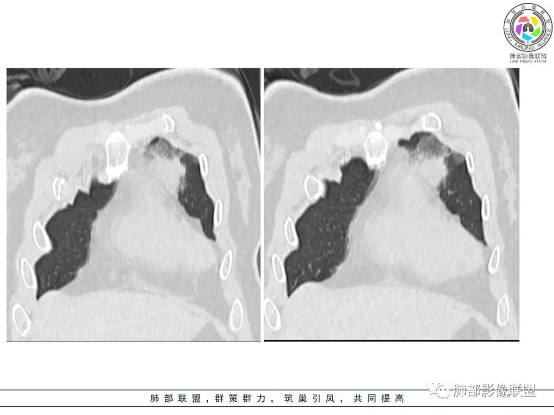 影像PPT - 【病例】粘液腺癌1例肺部CT影像特点及相关知识拓展-14 影像PPT - 【病例】粘液腺癌1例肺部CT影像特点及相关知识拓展-14