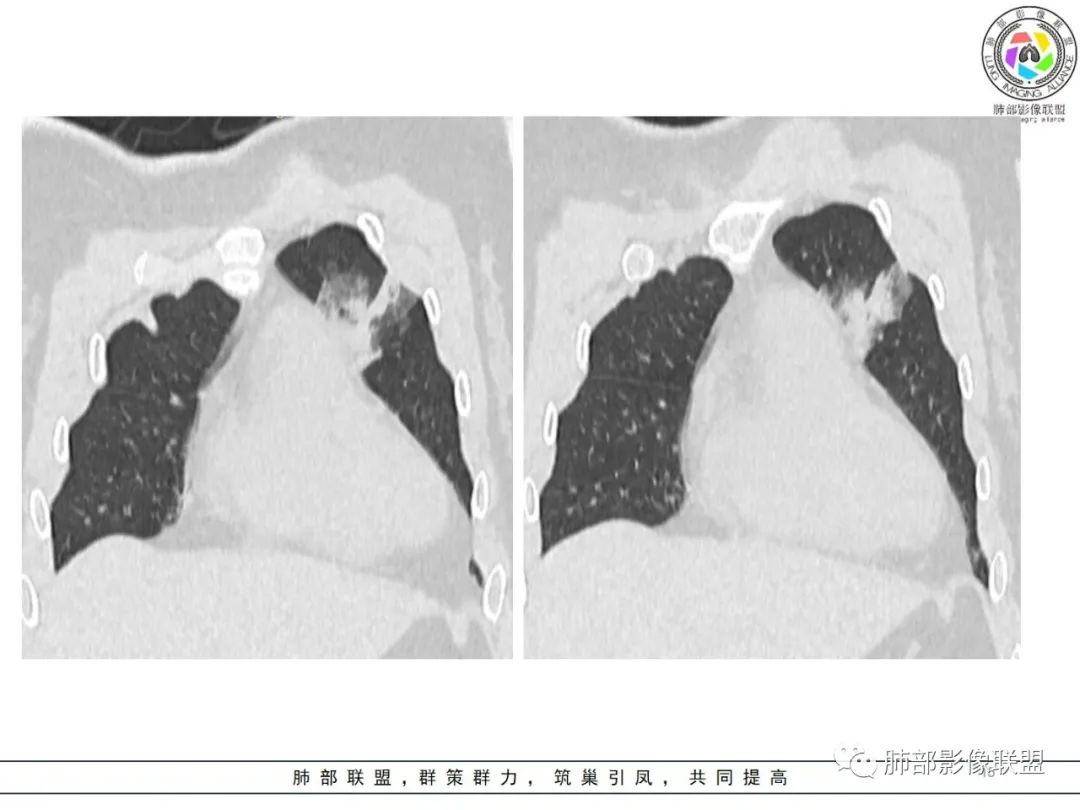 影像PPT - 【病例】粘液腺癌1例肺部CT影像特点及相关知识拓展-15 影像PPT - 【病例】粘液腺癌1例肺部CT影像特点及相关知识拓展-15