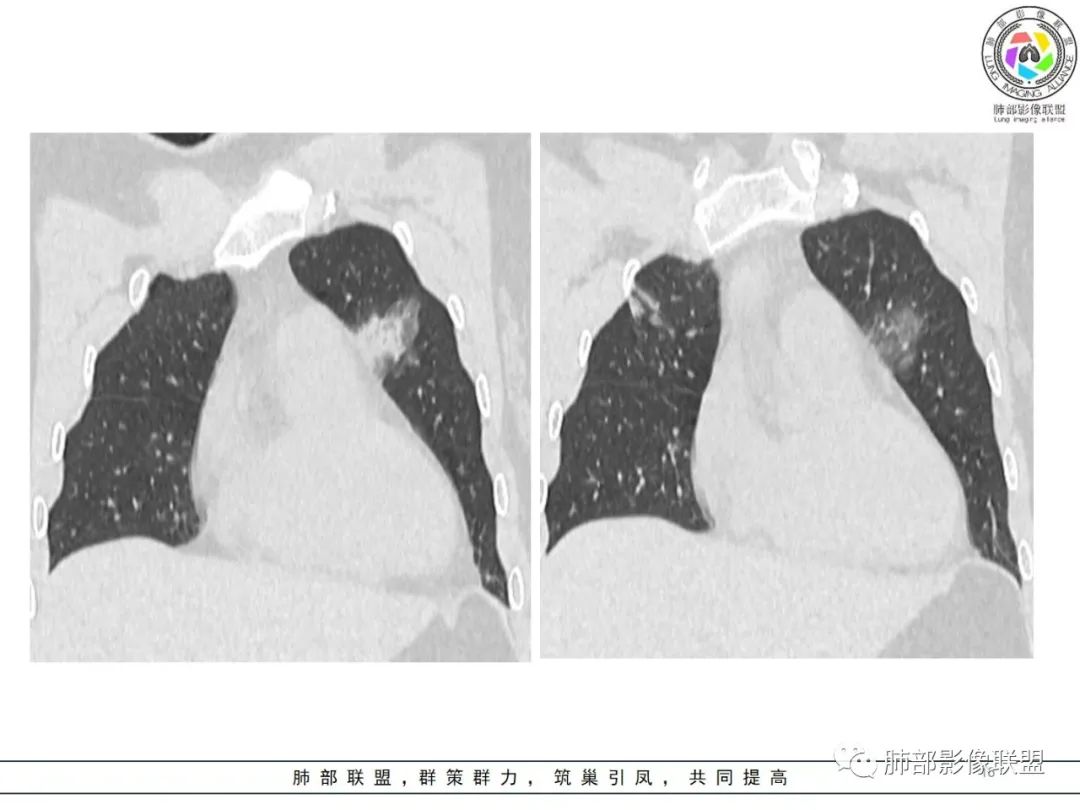 影像PPT - 【病例】粘液腺癌1例肺部CT影像特点及相关知识拓展-16 影像PPT - 【病例】粘液腺癌1例肺部CT影像特点及相关知识拓展-16