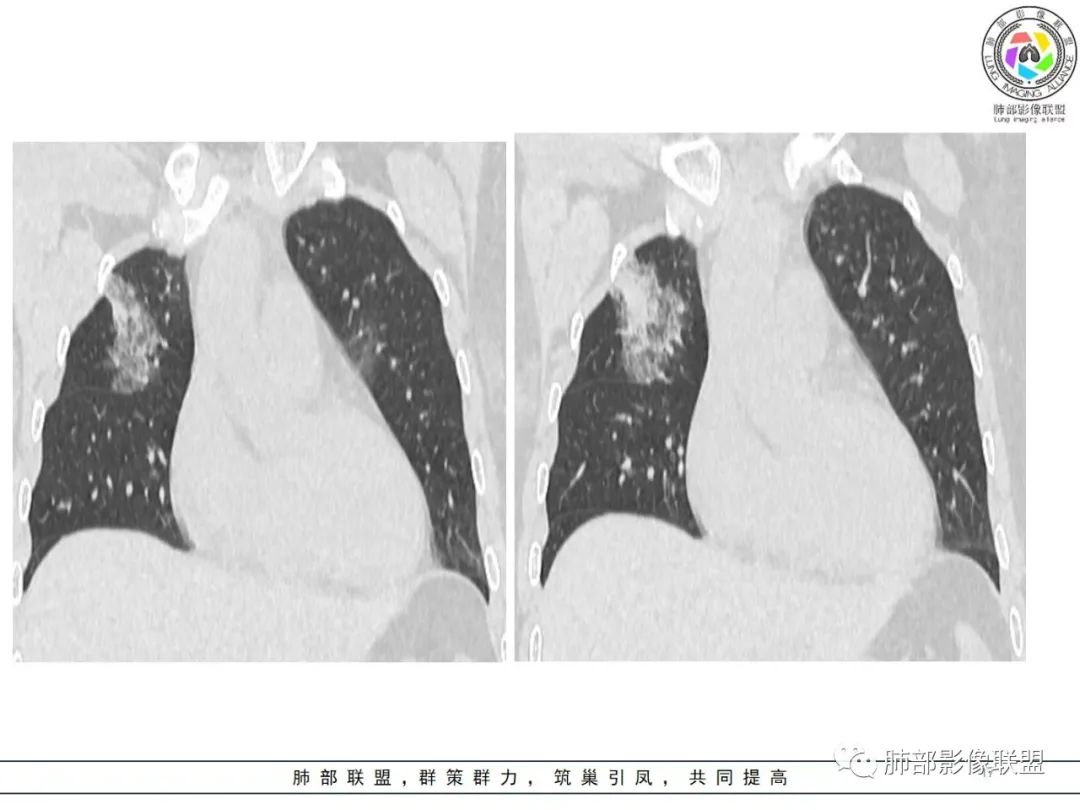 影像PPT - 【病例】粘液腺癌1例肺部CT影像特点及相关知识拓展-17 影像PPT - 【病例】粘液腺癌1例肺部CT影像特点及相关知识拓展-17