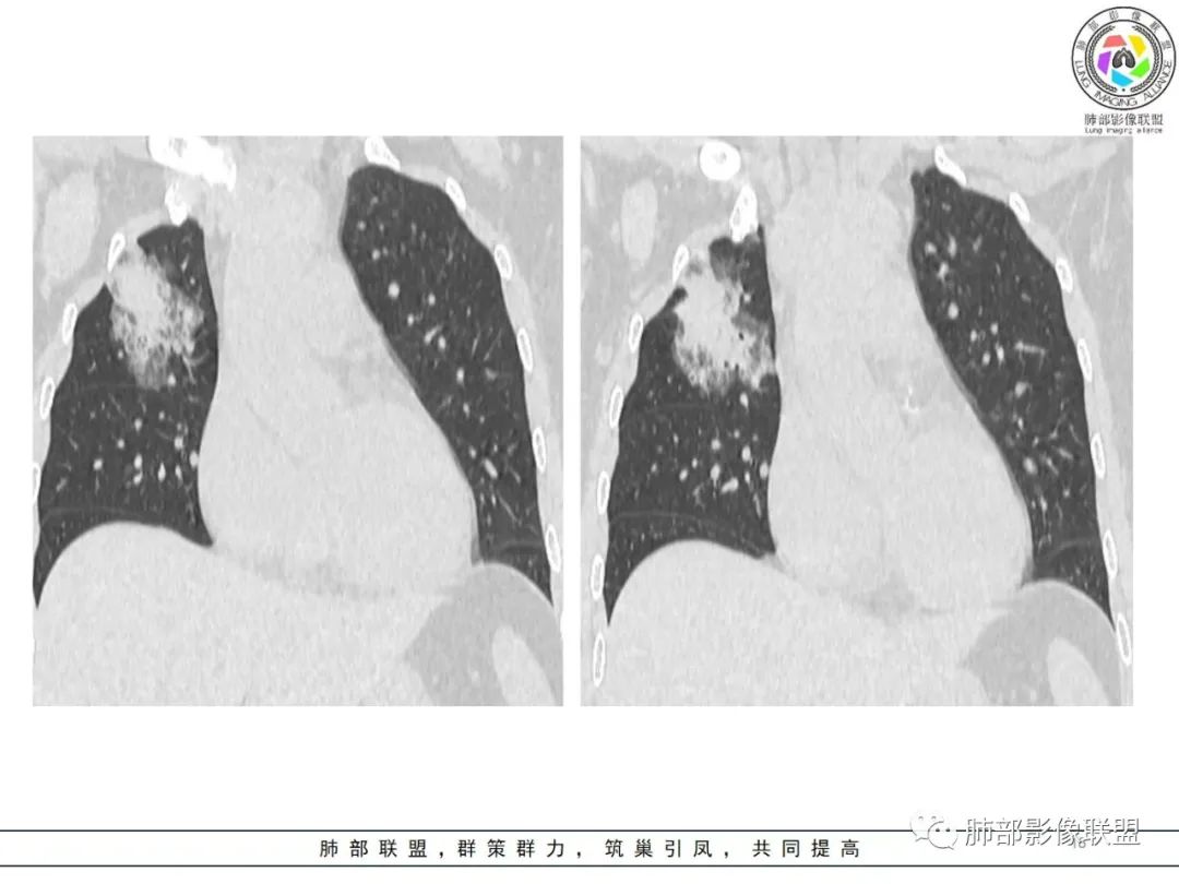 影像PPT - 【病例】粘液腺癌1例肺部CT影像特点及相关知识拓展-18 影像PPT - 【病例】粘液腺癌1例肺部CT影像特点及相关知识拓展-18