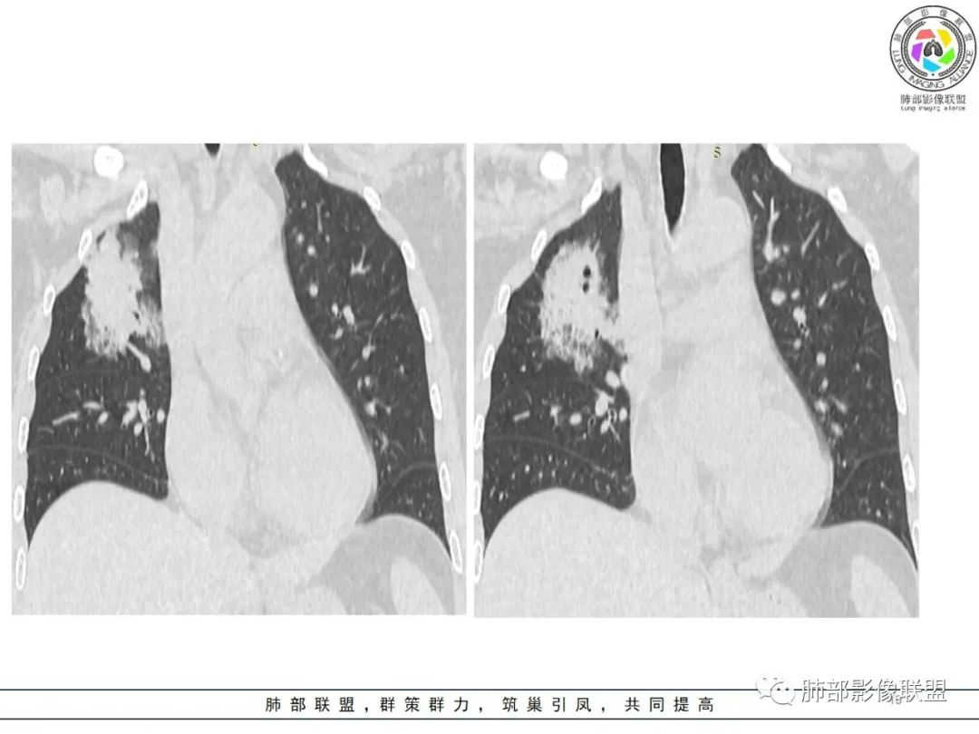 影像PPT - 【病例】粘液腺癌1例肺部CT影像特点及相关知识拓展-19 影像PPT - 【病例】粘液腺癌1例肺部CT影像特点及相关知识拓展-19