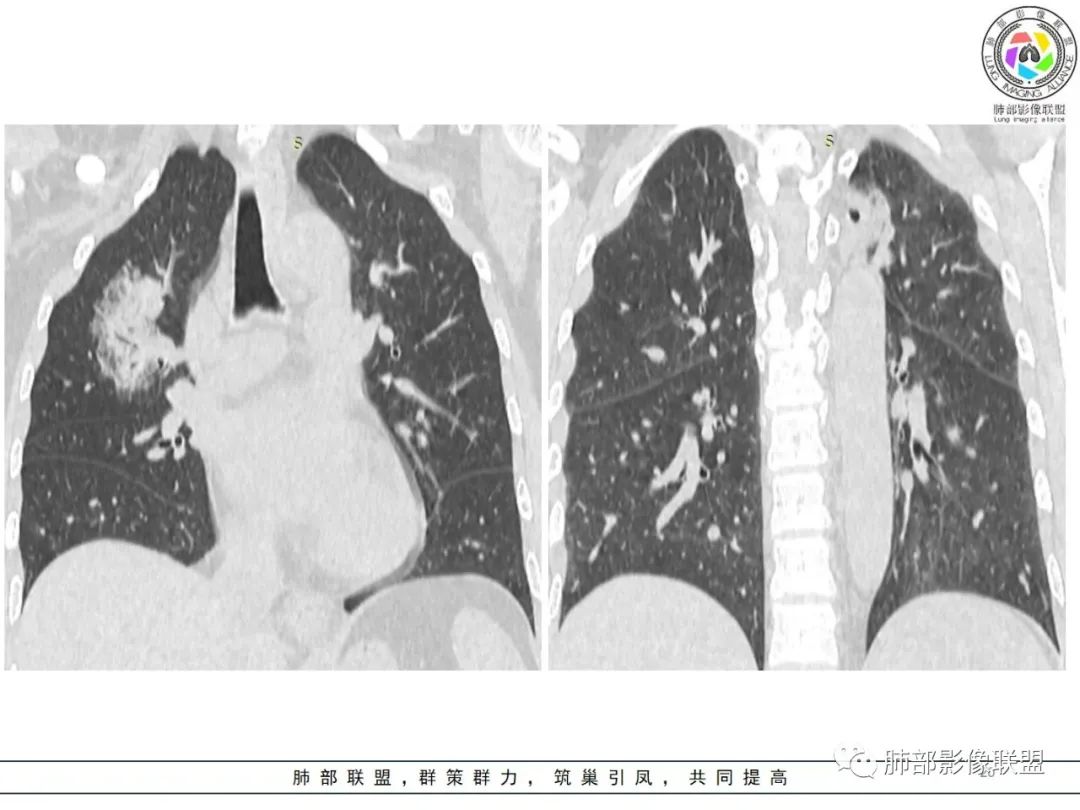 影像PPT - 【病例】粘液腺癌1例肺部CT影像特点及相关知识拓展-20 影像PPT - 【病例】粘液腺癌1例肺部CT影像特点及相关知识拓展-20