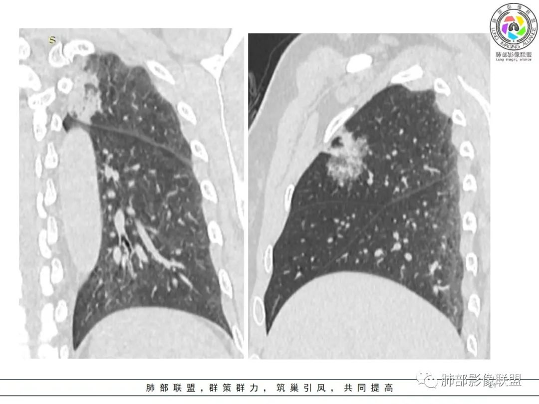 影像PPT - 【病例】粘液腺癌1例肺部CT影像特点及相关知识拓展-21 影像PPT - 【病例】粘液腺癌1例肺部CT影像特点及相关知识拓展-21