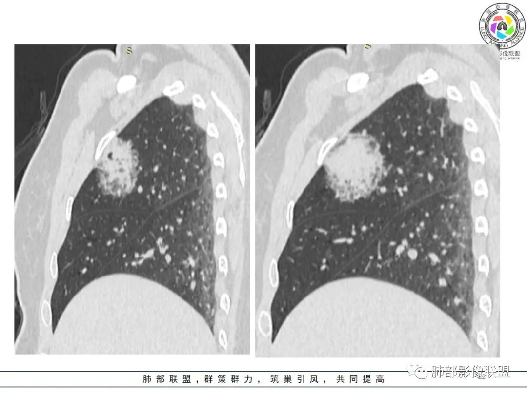 影像PPT - 【病例】粘液腺癌1例肺部CT影像特点及相关知识拓展-22 影像PPT - 【病例】粘液腺癌1例肺部CT影像特点及相关知识拓展-22