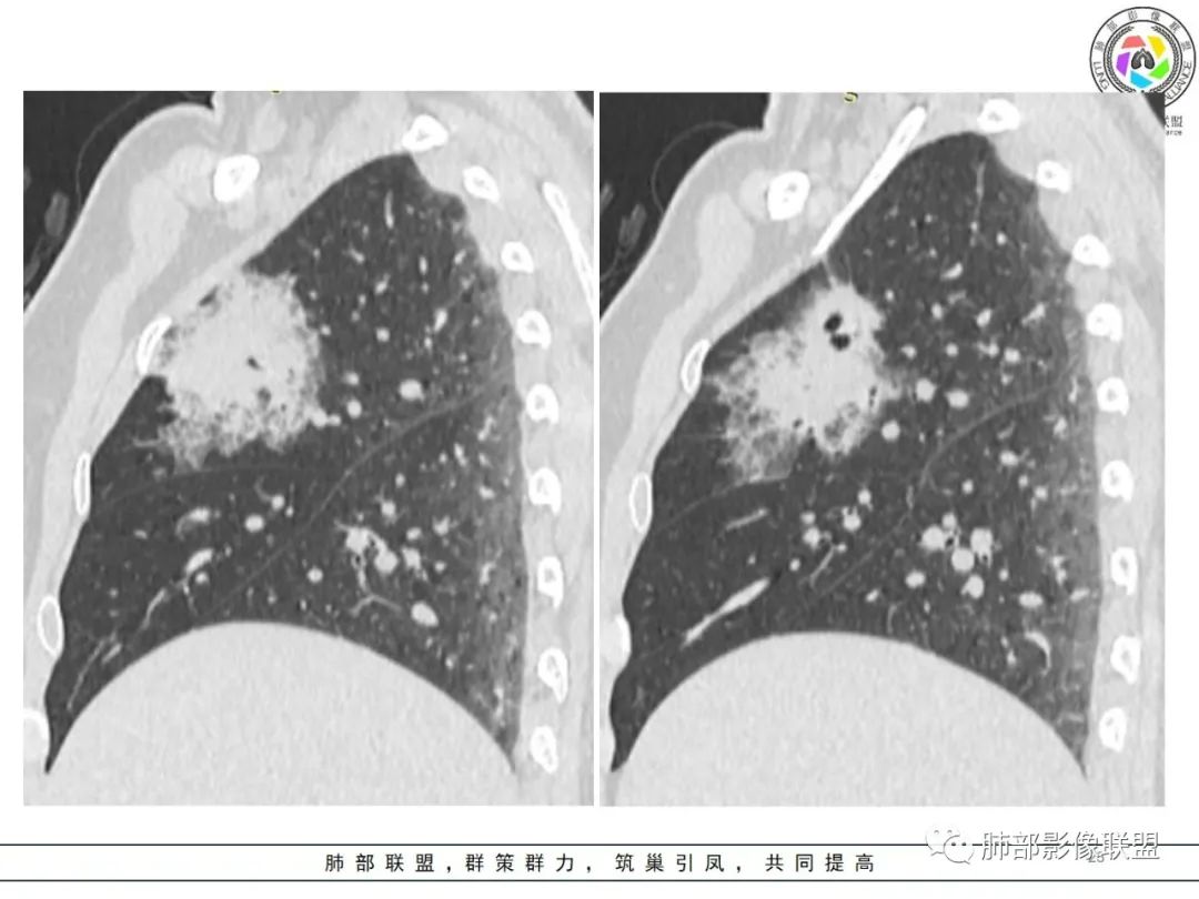 影像PPT - 【病例】粘液腺癌1例肺部CT影像特点及相关知识拓展-23 影像PPT - 【病例】粘液腺癌1例肺部CT影像特点及相关知识拓展-23