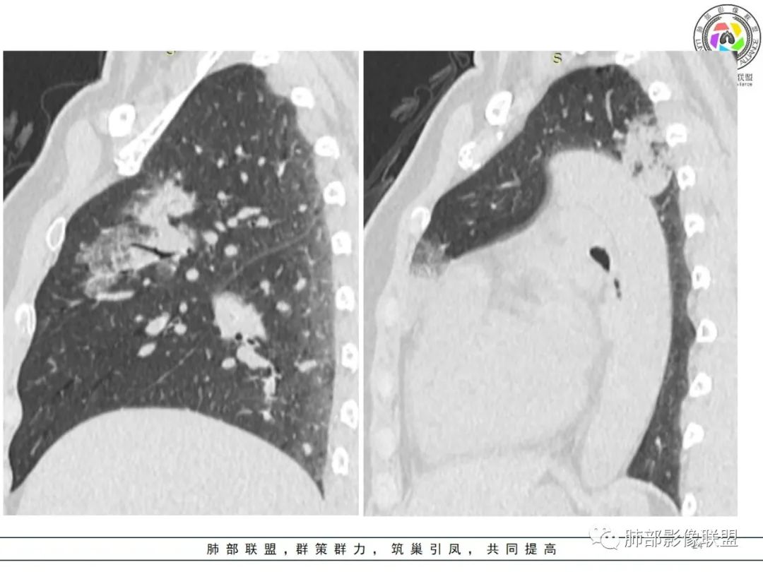影像PPT - 【病例】粘液腺癌1例肺部CT影像特点及相关知识拓展-24 影像PPT - 【病例】粘液腺癌1例肺部CT影像特点及相关知识拓展-24