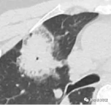 影像PPT - 【病例】粘液腺癌1例肺部CT影像特点及相关知识拓展-28 影像PPT - 【病例】粘液腺癌1例肺部CT影像特点及相关知识拓展-28