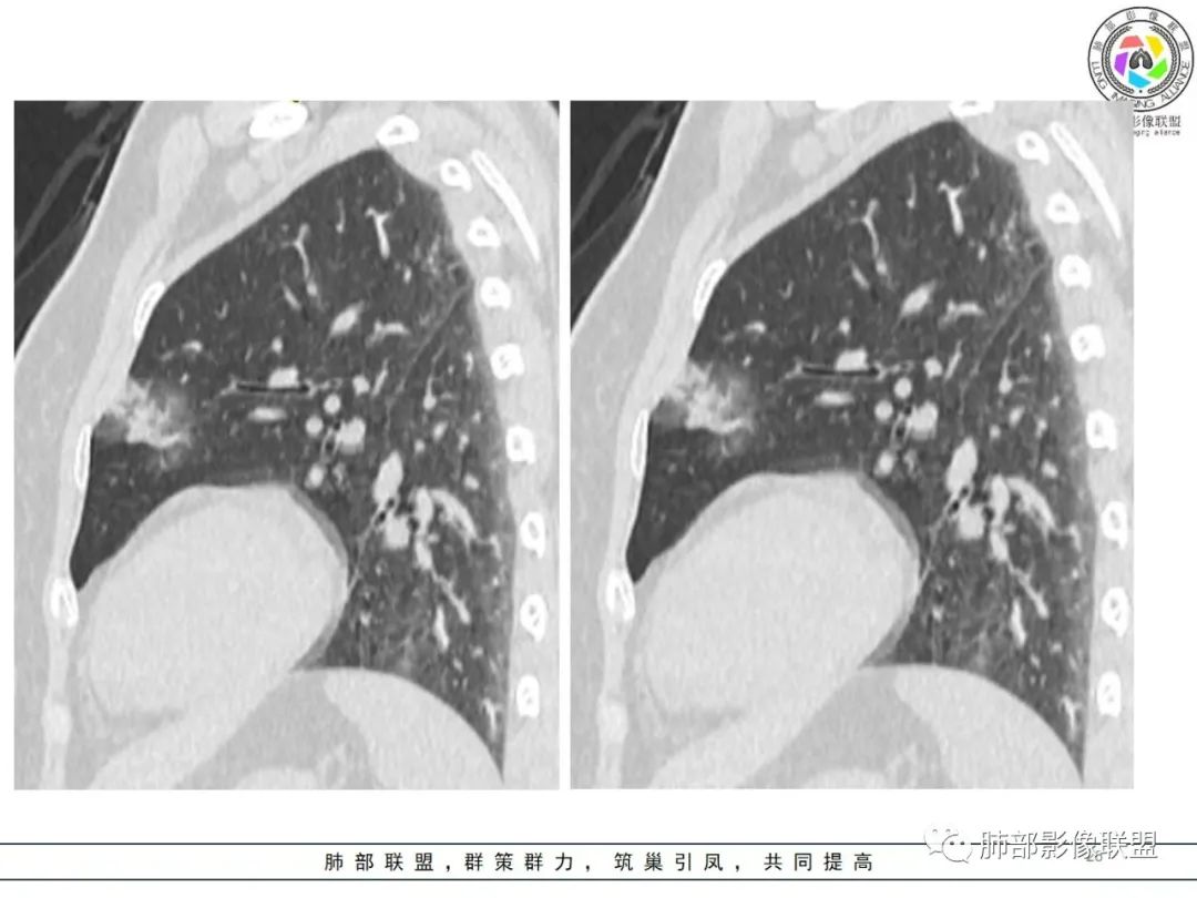 影像PPT - 【病例】粘液腺癌1例肺部CT影像特点及相关知识拓展-26 影像PPT - 【病例】粘液腺癌1例肺部CT影像特点及相关知识拓展-26