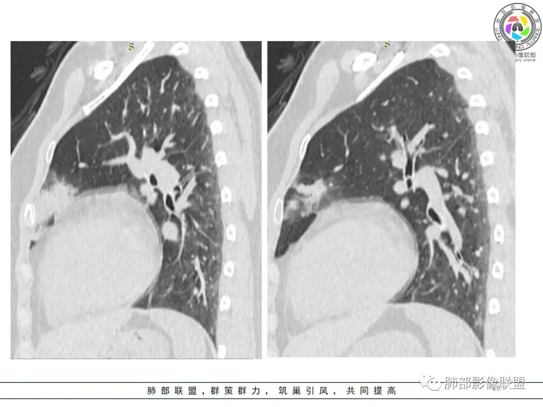 影像PPT - 【病例】粘液腺癌1例肺部CT影像特点及相关知识拓展-25 影像PPT - 【病例】粘液腺癌1例肺部CT影像特点及相关知识拓展-25