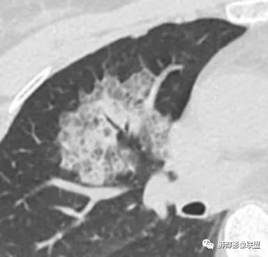 影像PPT - 【病例】粘液腺癌1例肺部CT影像特点及相关知识拓展-29 影像PPT - 【病例】粘液腺癌1例肺部CT影像特点及相关知识拓展-29