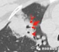 影像PPT - 【病例】粘液腺癌1例肺部CT影像特点及相关知识拓展-36 影像PPT - 【病例】粘液腺癌1例肺部CT影像特点及相关知识拓展-36