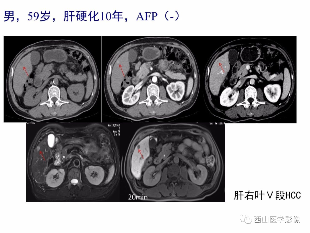 影像PPT - 【PPT】普美显临床应用病例解析-11