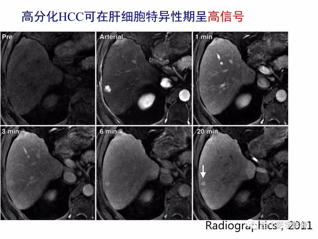 影像PPT - 【PPT】普美显临床应用病例解析-12