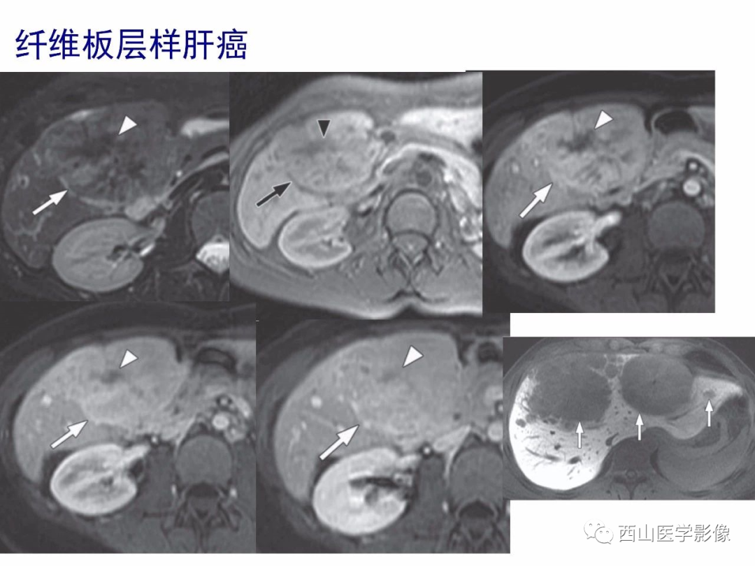 影像PPT - 【PPT】普美显临床应用病例解析-14