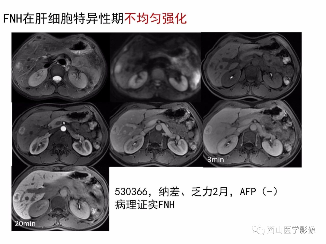 影像PPT - 【PPT】普美显临床应用病例解析-16