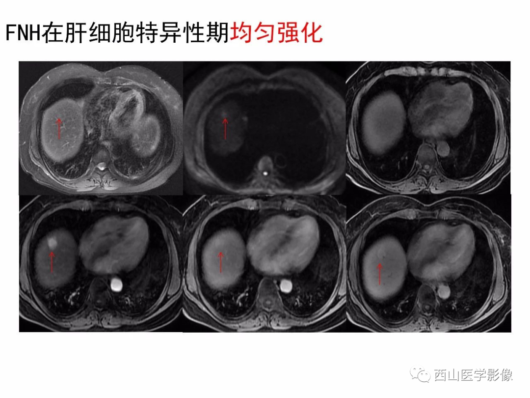 影像PPT - 【PPT】普美显临床应用病例解析-17