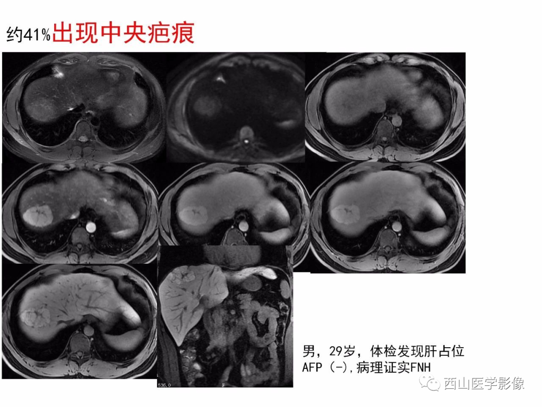 影像PPT - 【PPT】普美显临床应用病例解析-18
