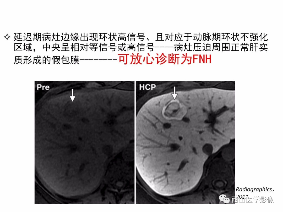 影像PPT - 【PPT】普美显临床应用病例解析-19