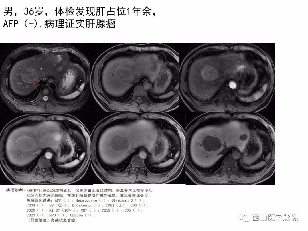 影像PPT - 【PPT】普美显临床应用病例解析-25