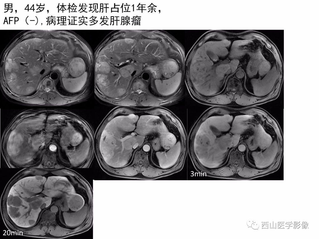 影像PPT - 【PPT】普美显临床应用病例解析-26