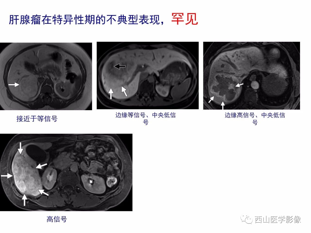 影像PPT - 【PPT】普美显临床应用病例解析-27