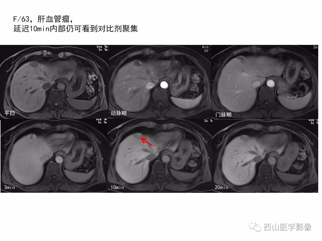 影像PPT - 【PPT】普美显临床应用病例解析-32