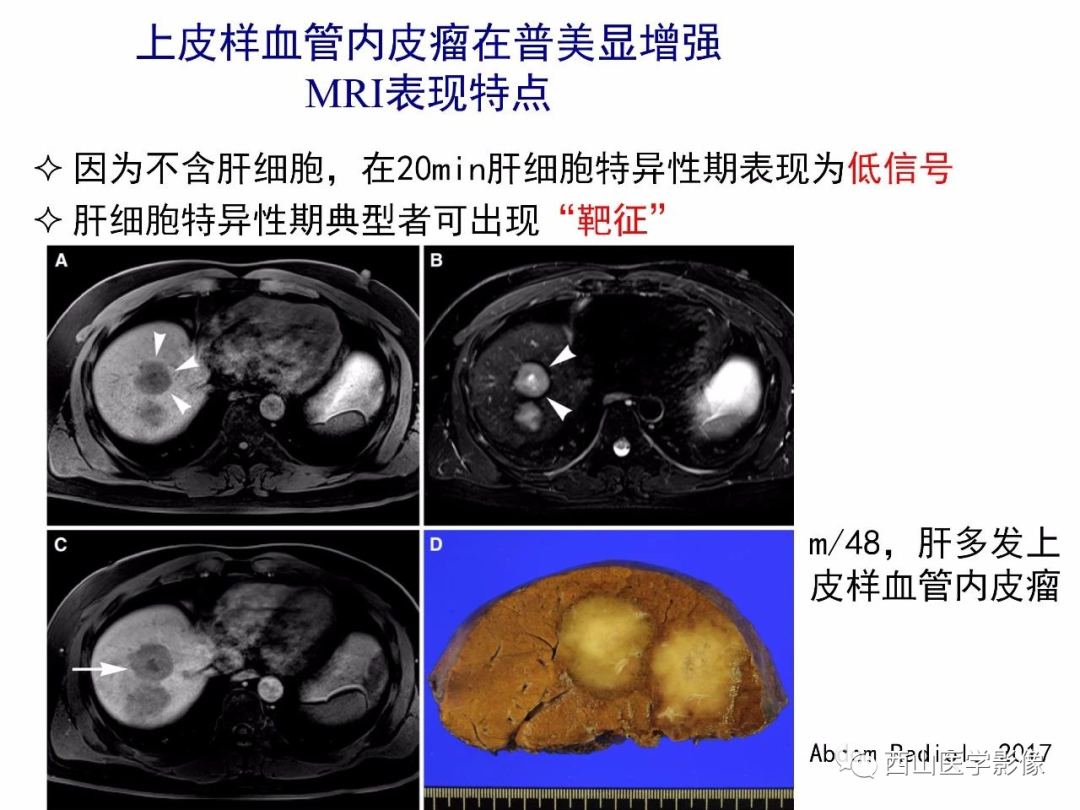 影像PPT - 【PPT】普美显临床应用病例解析-38
