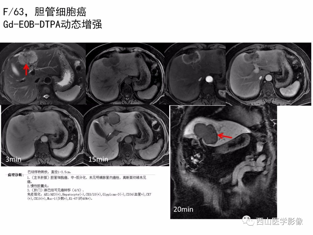 影像PPT - 【PPT】普美显临床应用病例解析-40