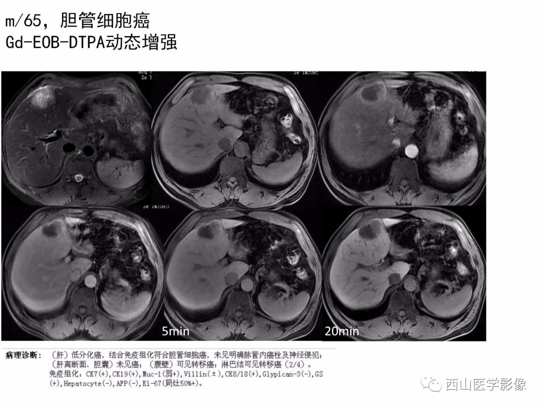 影像PPT - 【PPT】普美显临床应用病例解析-41