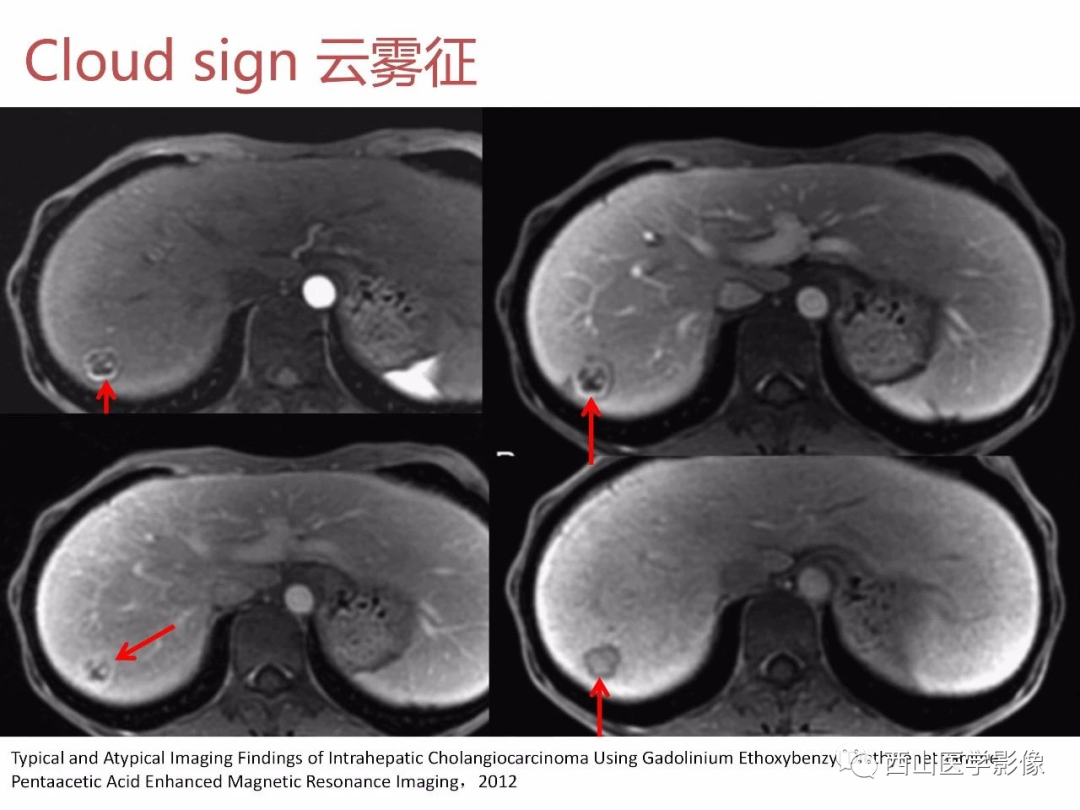 影像PPT - 【PPT】普美显临床应用病例解析-42