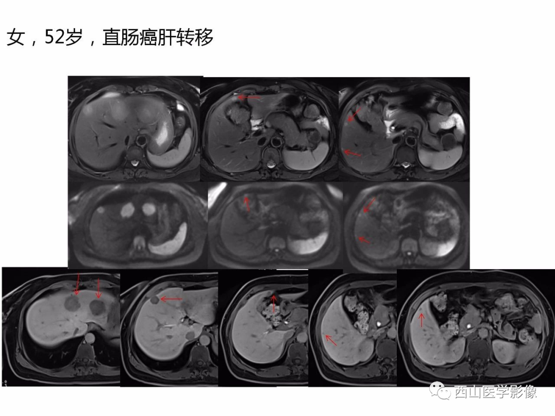 影像PPT - 【PPT】普美显临床应用病例解析-44