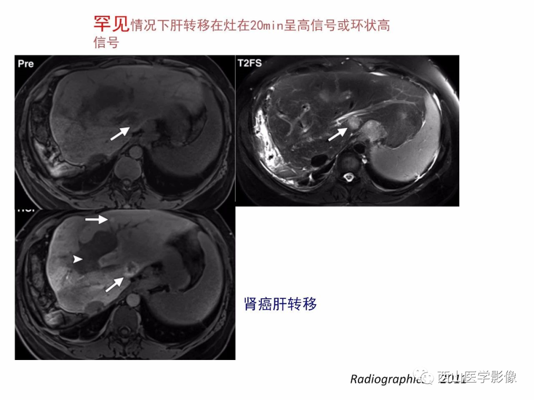 影像PPT - 【PPT】普美显临床应用病例解析-45