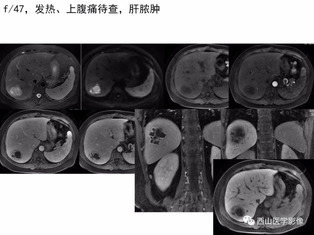影像PPT - 【PPT】普美显临床应用病例解析-47